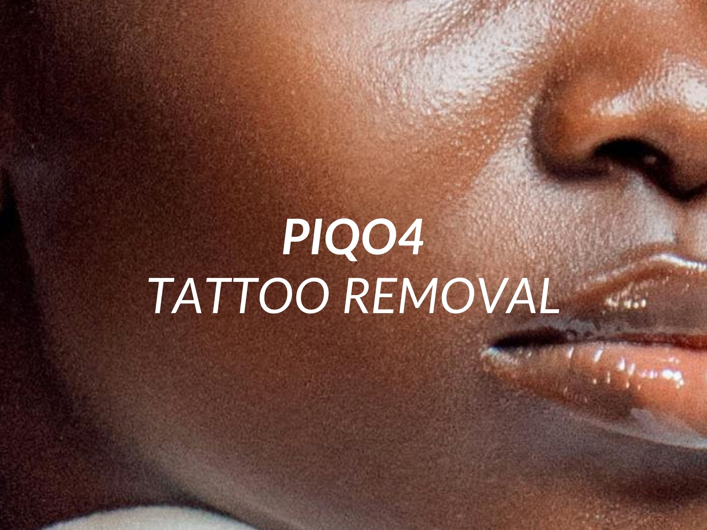 PiQo4 Tattoo Removal treatment at Beauty Ranch Medical Spa