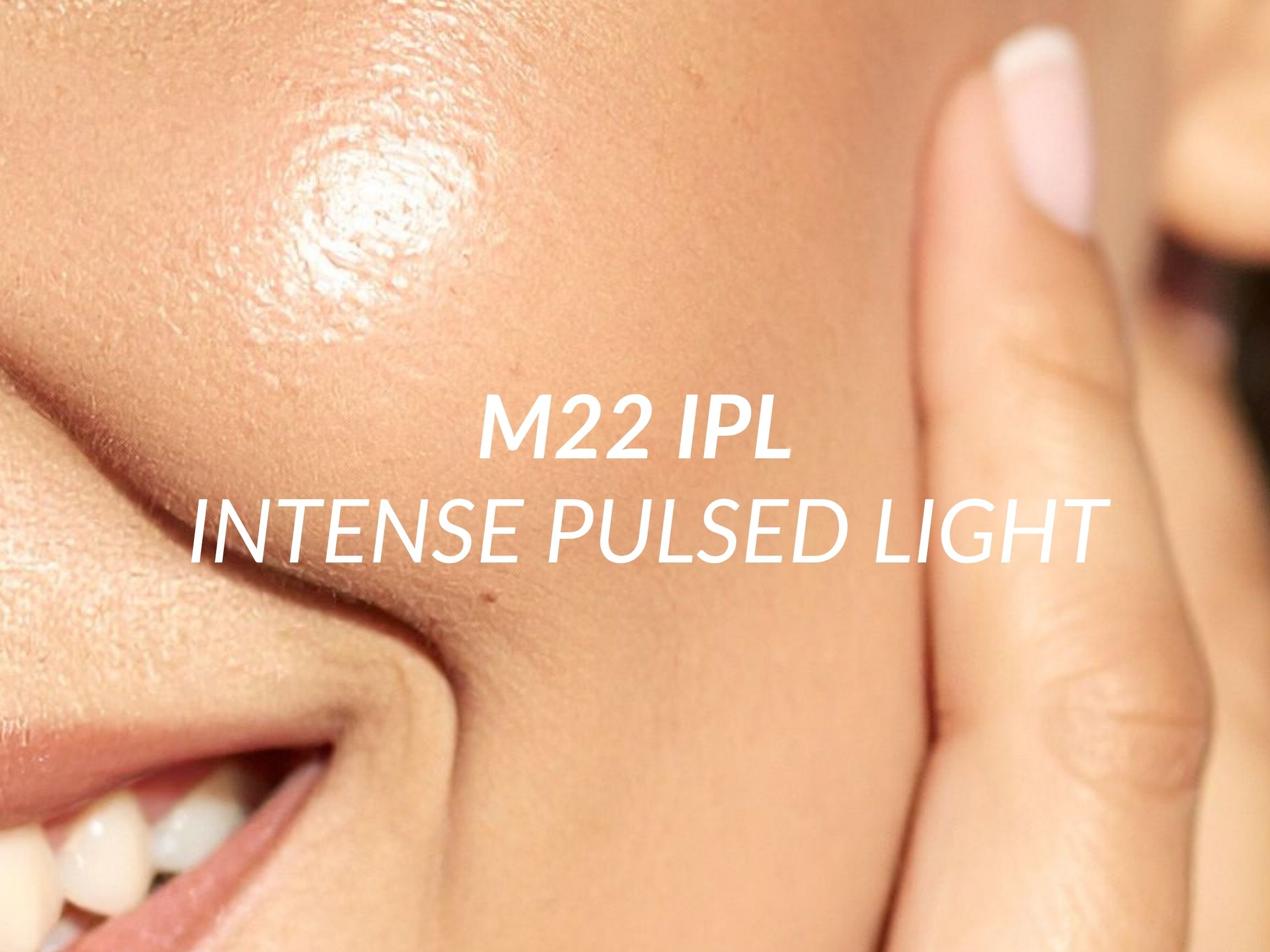 M22 IPL treatment at Beauty Ranch Medical Spa