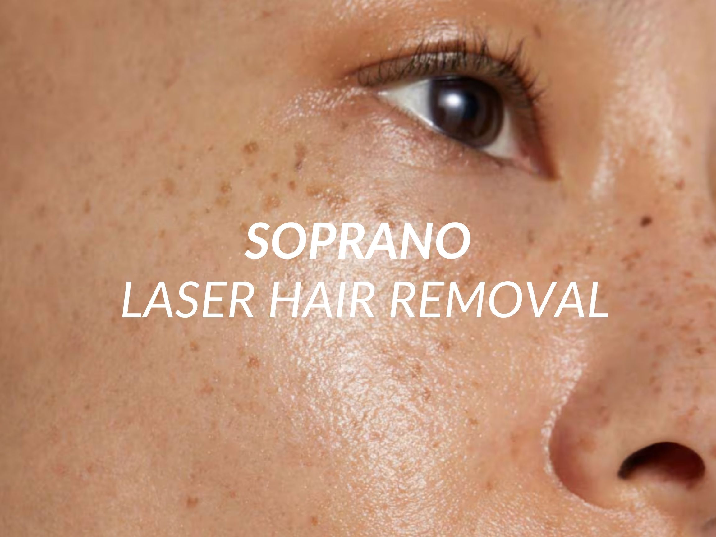 Soprano treatment at Beauty Ranch Medical Spa