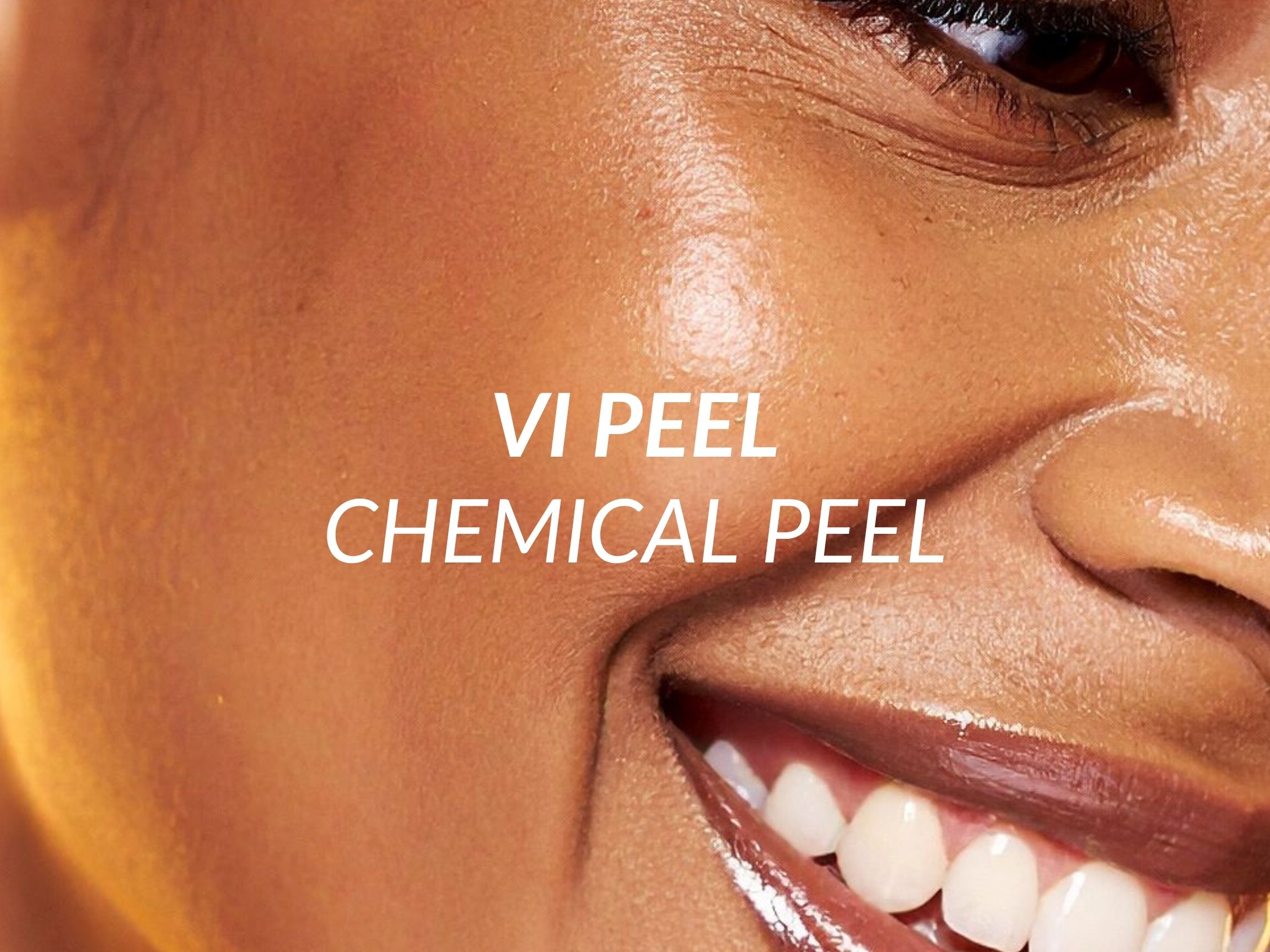 VI Peel treatment at Beauty Ranch Medical Spa
