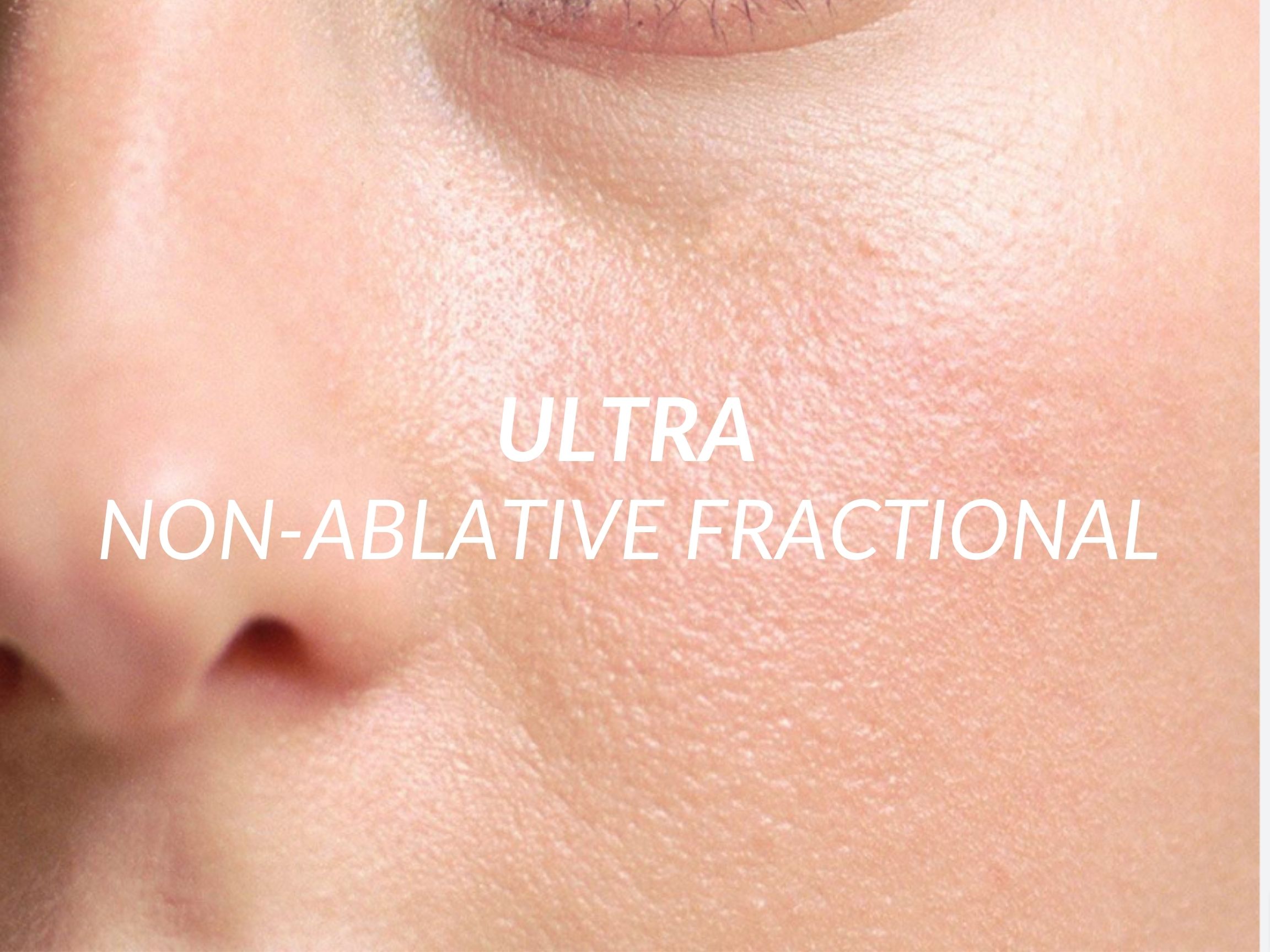 Ultra treatment at Beauty Ranch Medical Spa