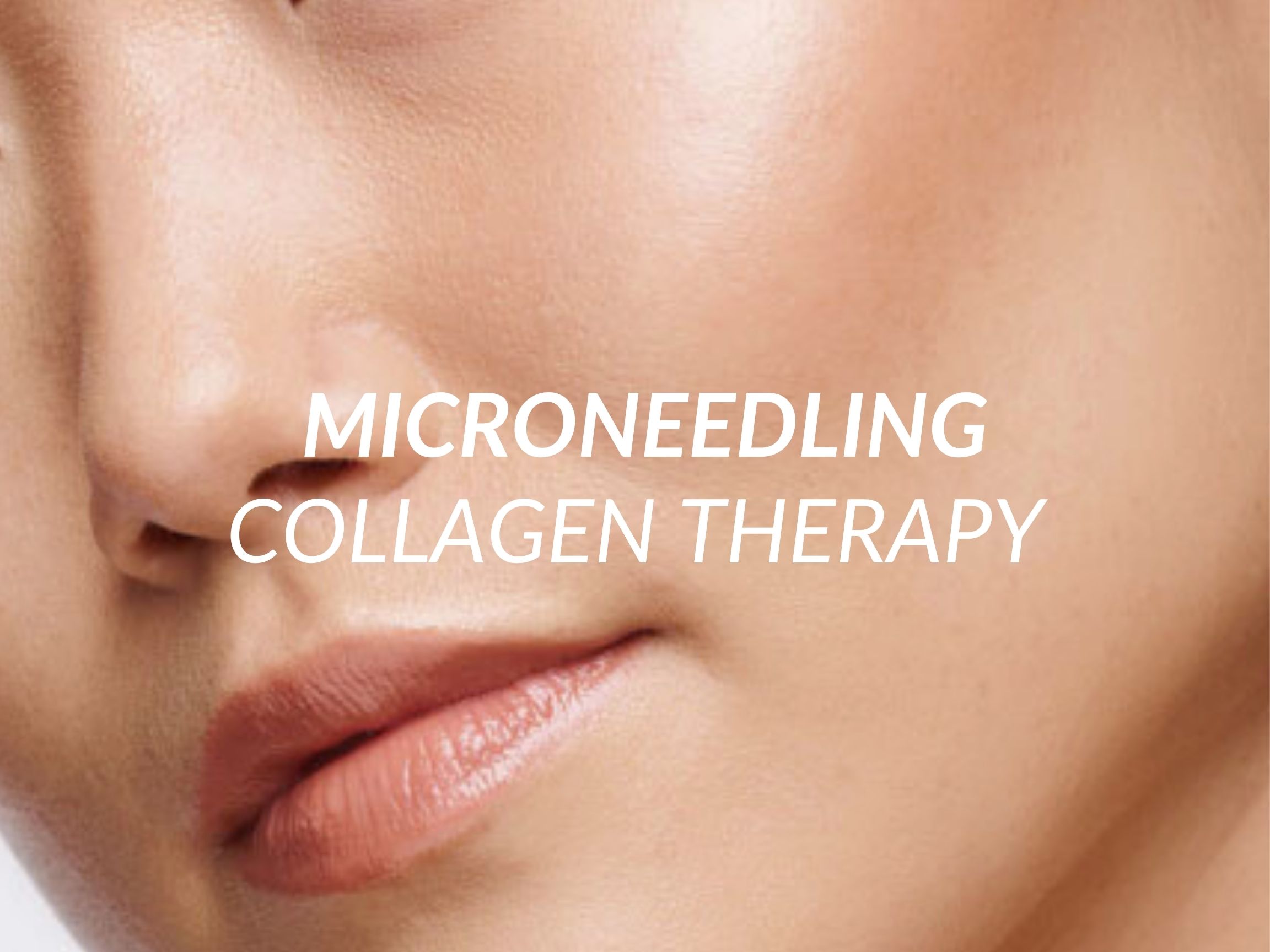 Microneedling treatment at Beauty Ranch Medical Spa