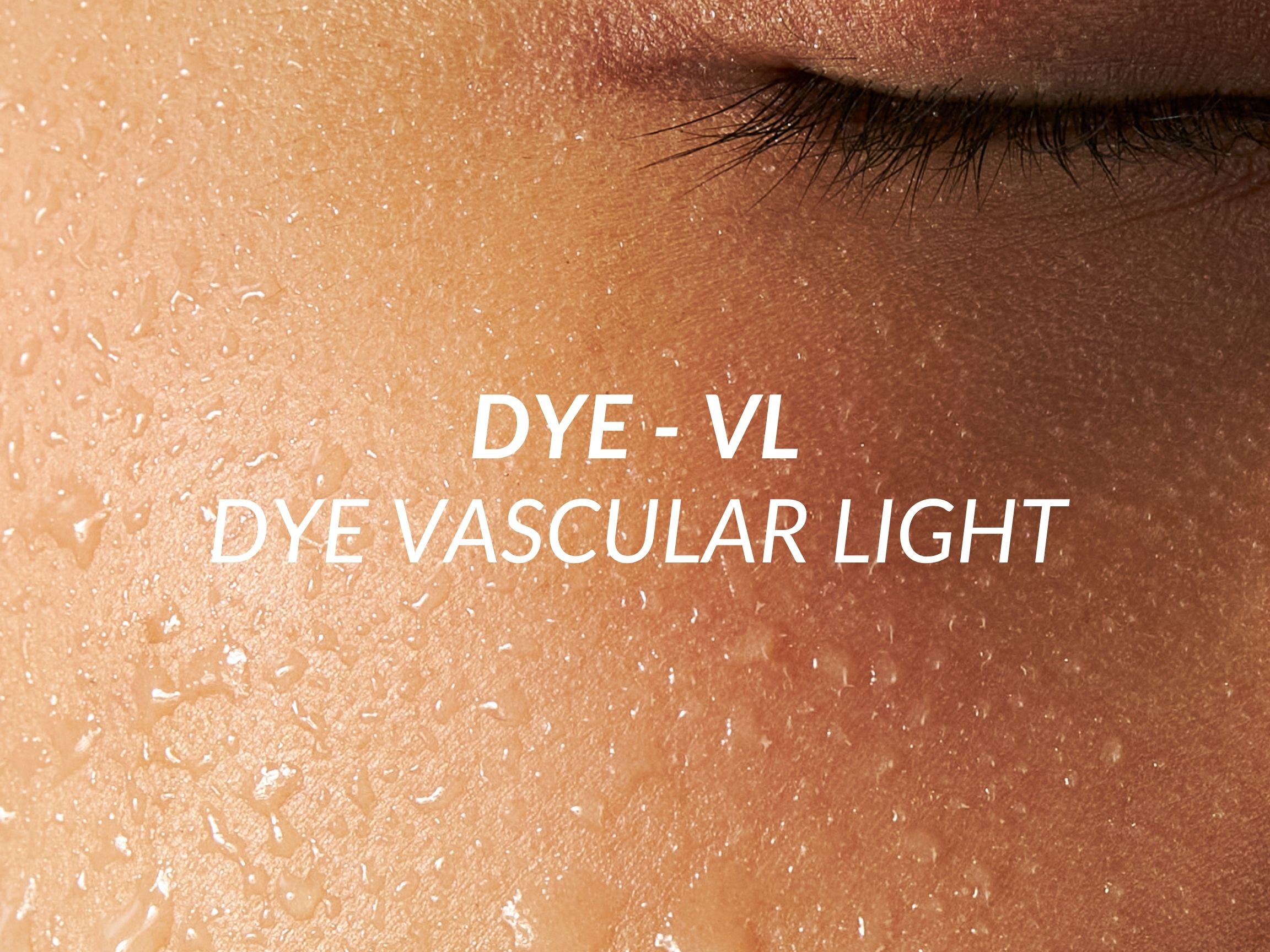 Dye-VL treatment at Beauty Ranch Medical Spa