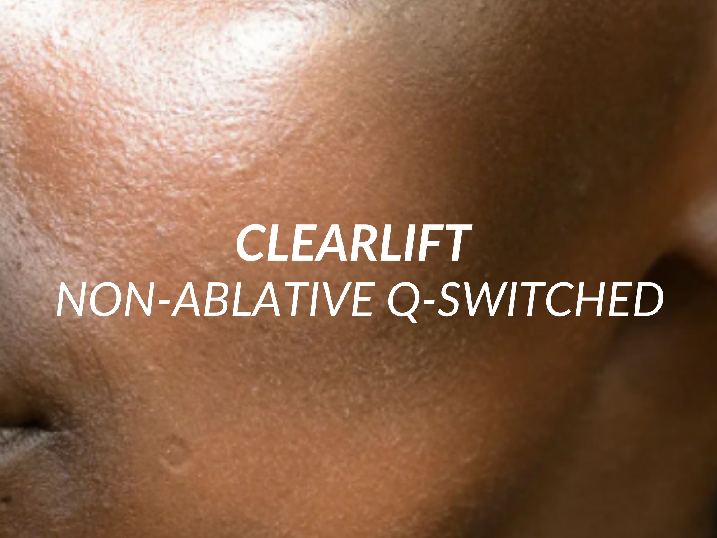 ClearLift treatment at Beauty Ranch Medical Spa