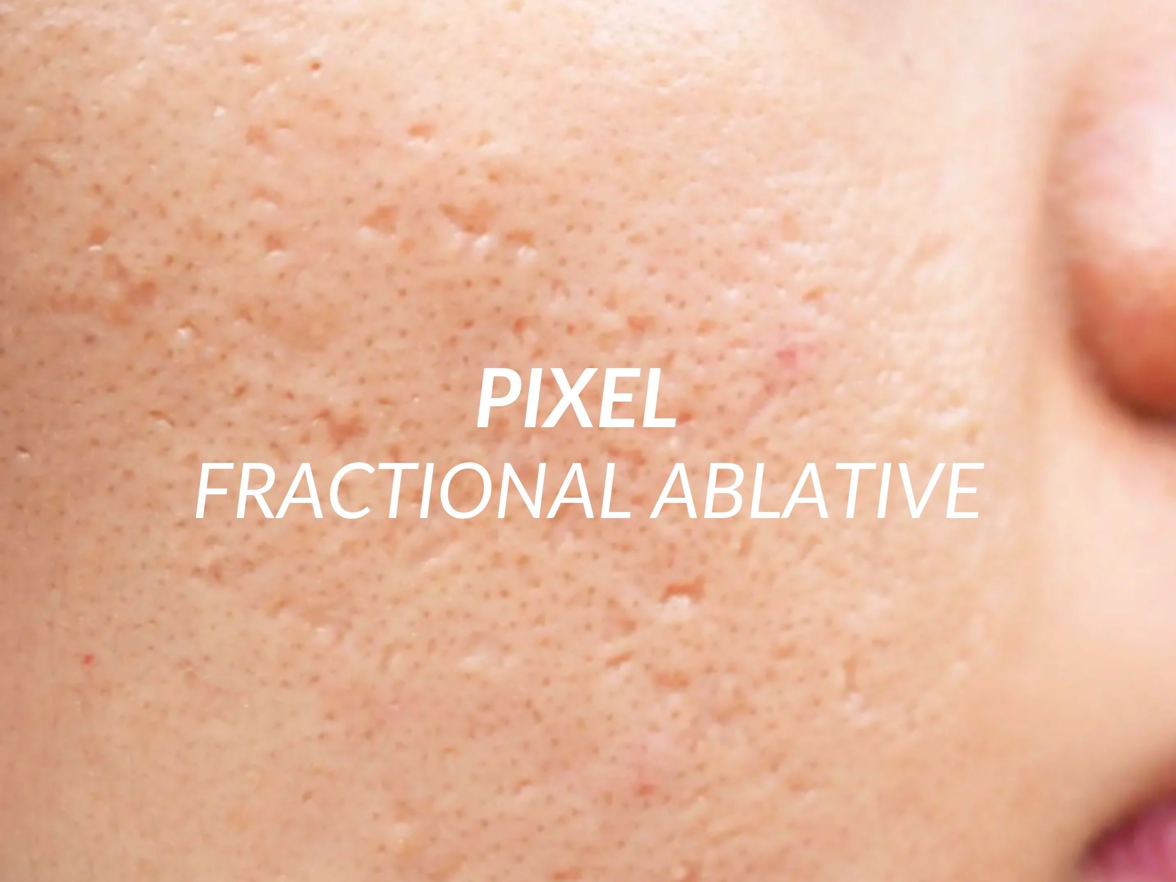 Pixel treatment at Beauty Ranch Medical Spa