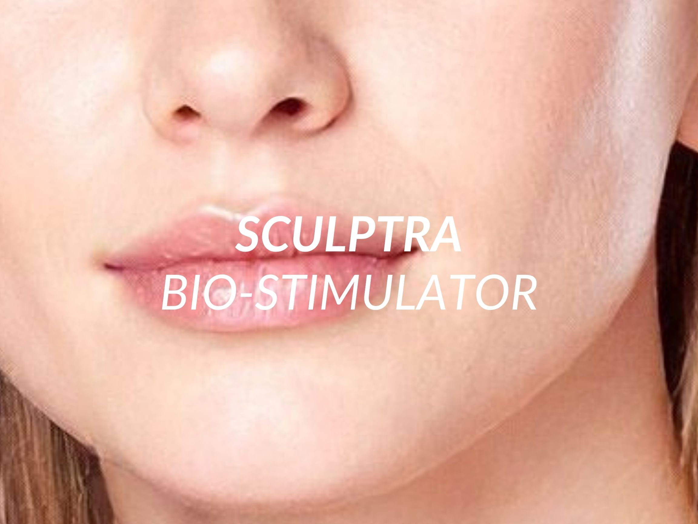 Sculptra treatment at Beauty Ranch Medical Spa
