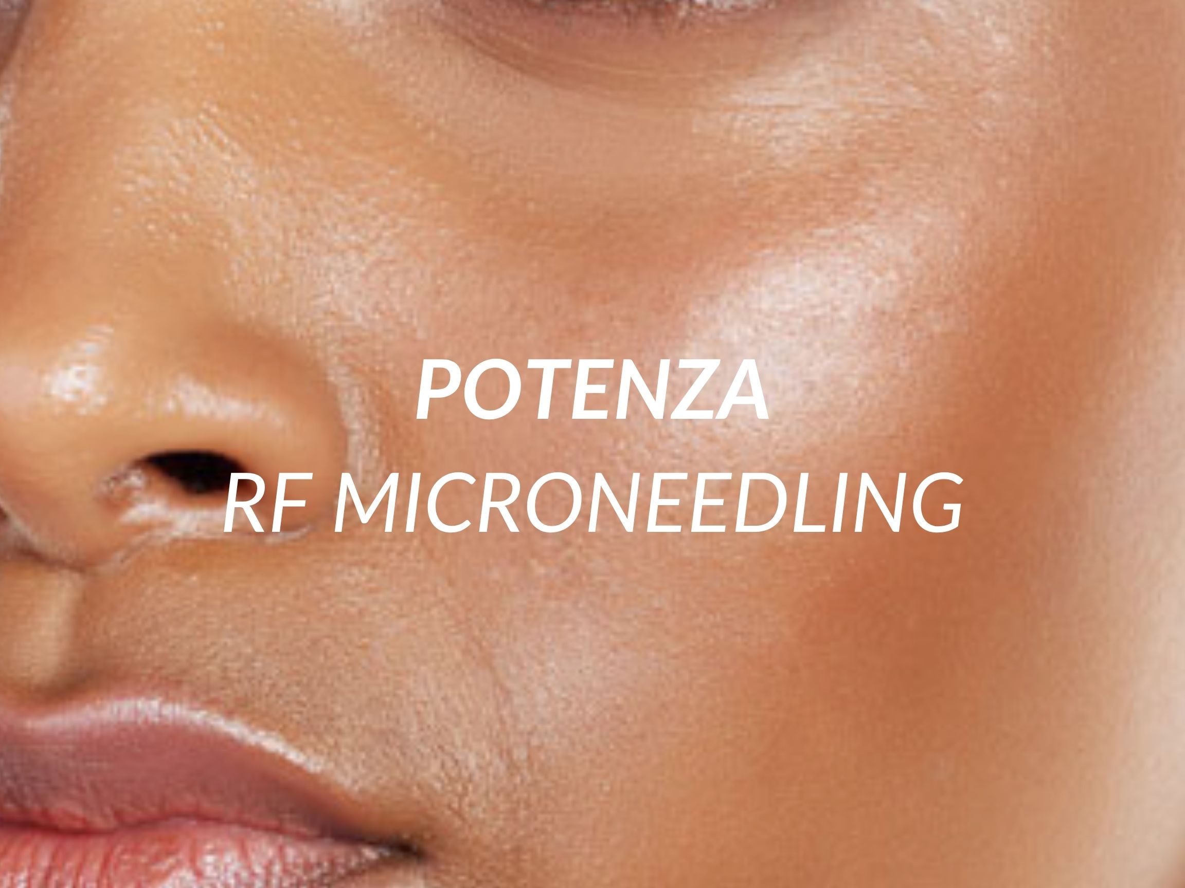 Potenza RF Microneedling treatment at Beauty Ranch Medical Spa