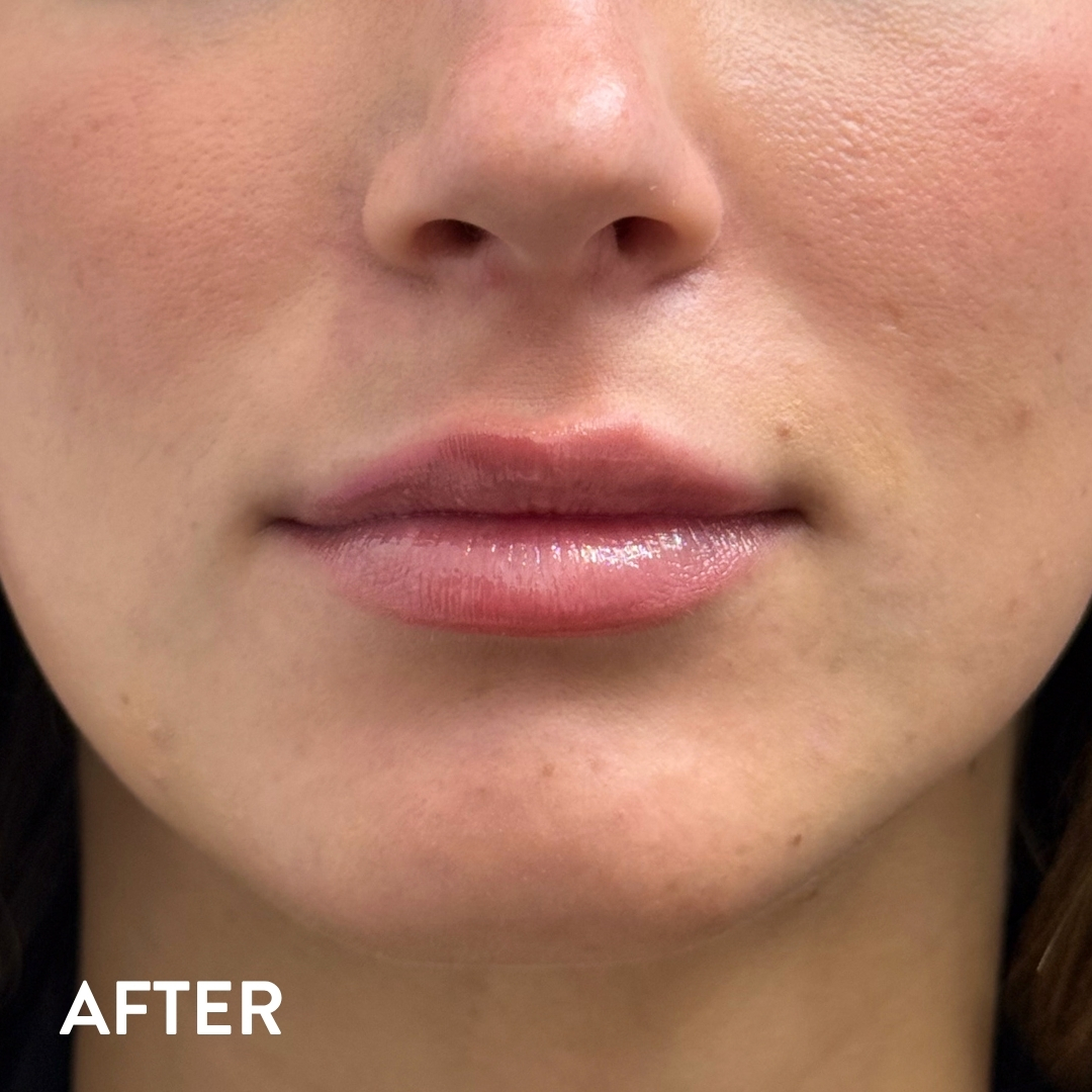 Dermal filler lip enhancement after — Beauty Ranch Medical Spa