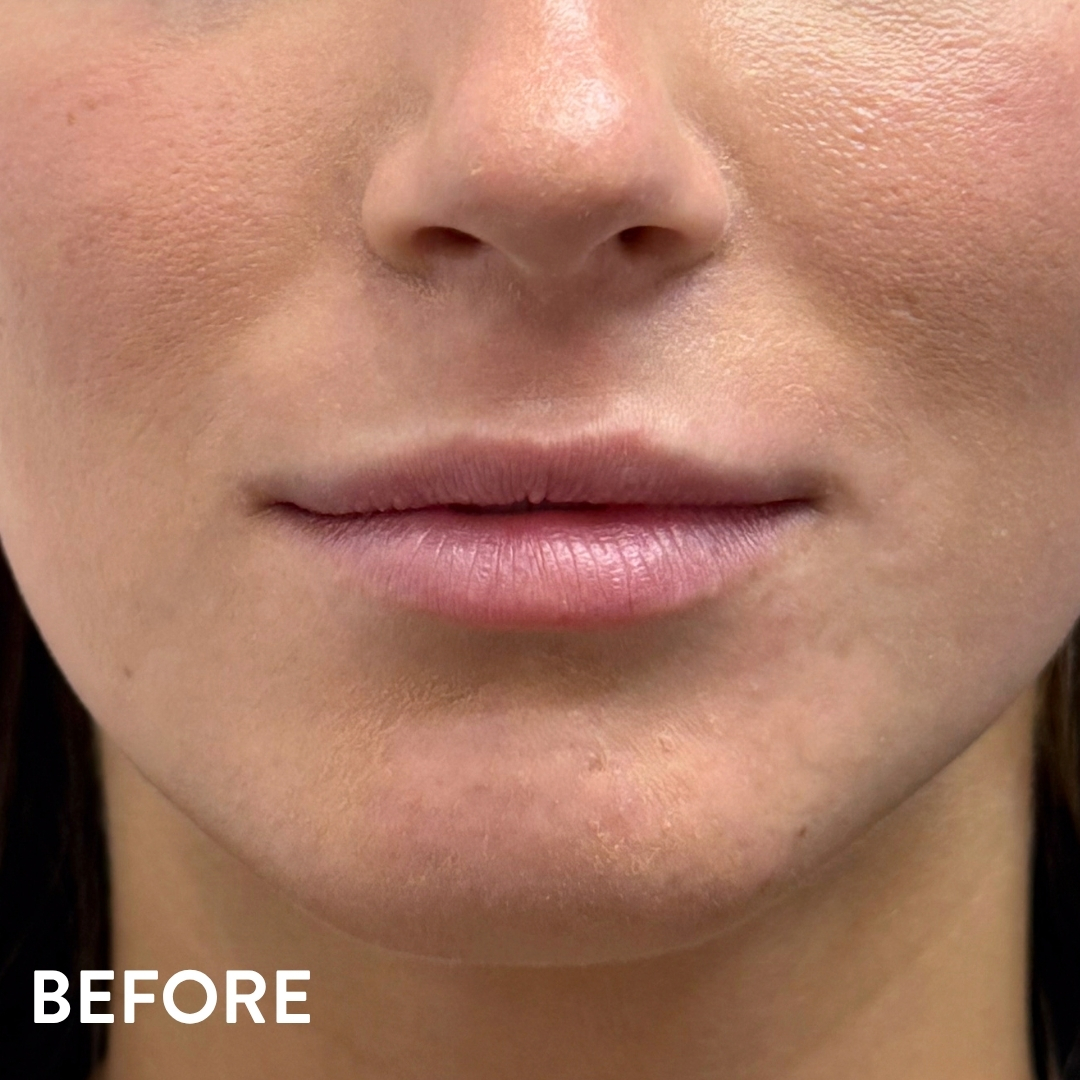 Dermal filler lip enhancement before — Beauty Ranch Medical Spa