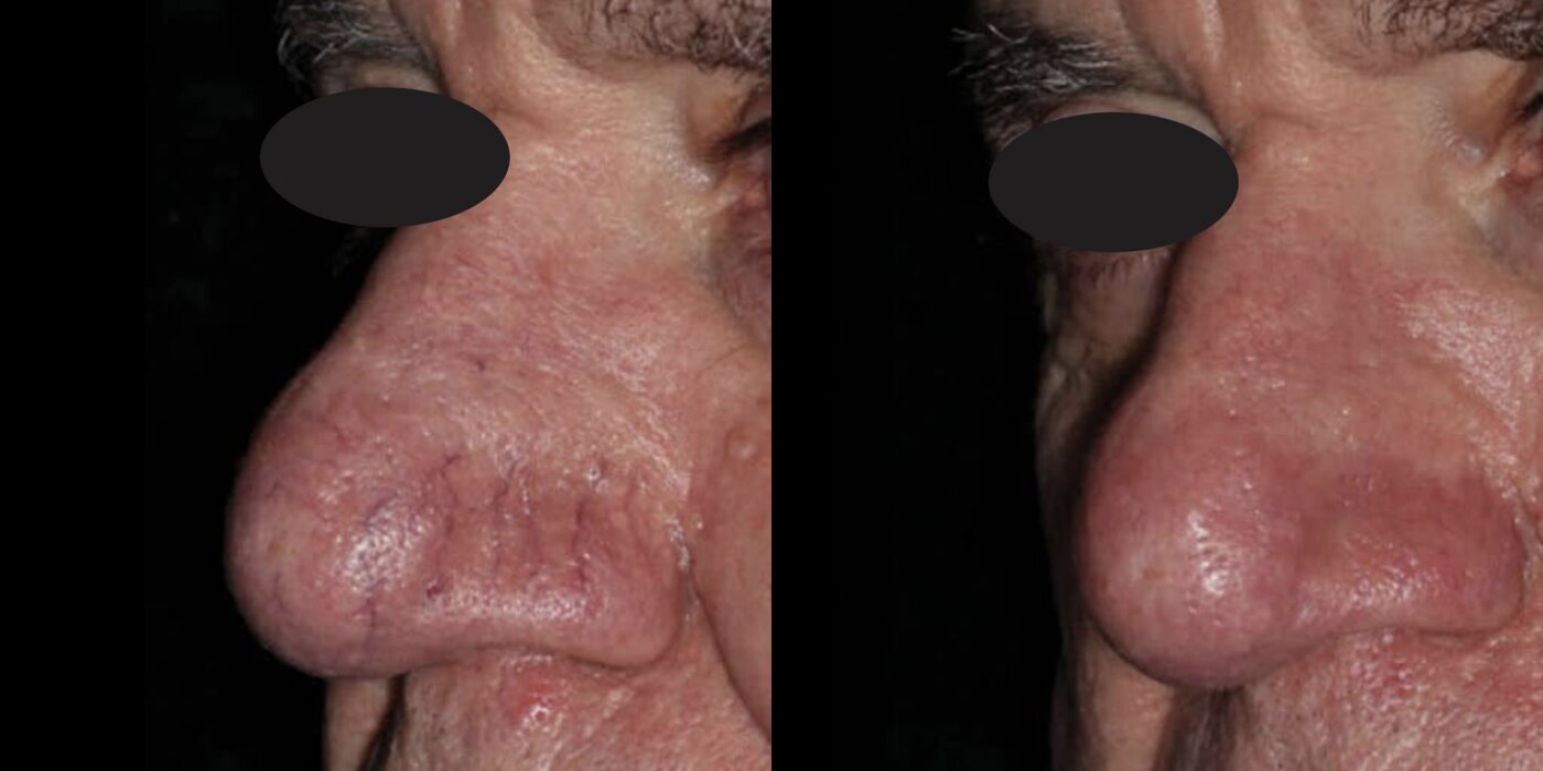M22 IPL nose redness and vessels before and after — Beauty Ranch Medical Spa