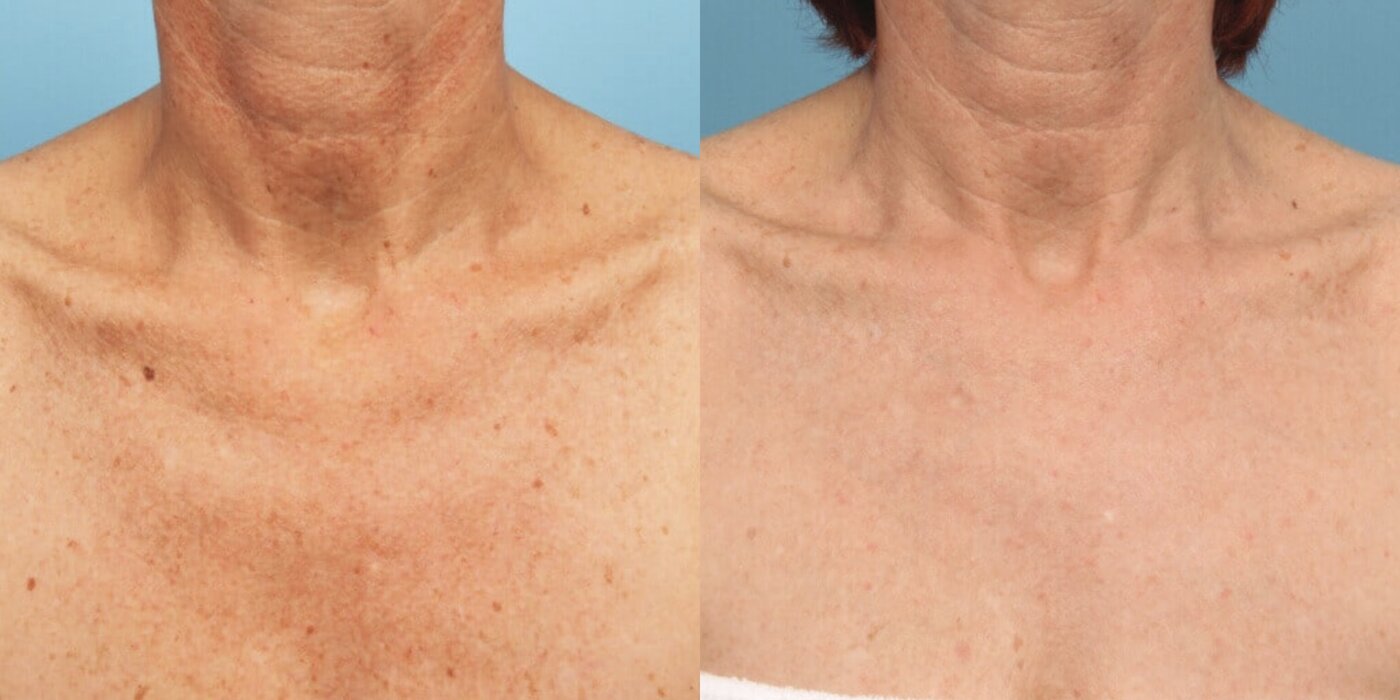 M22 IPL neck and chest sun damage before and after — Beauty Ranch Medical Spa