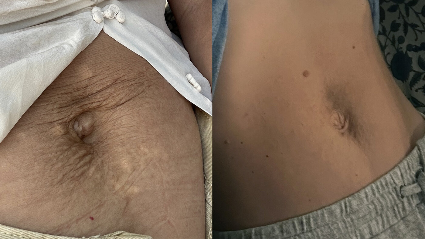 Potenza RF Microneedling tummy before and after — Beauty Ranch Medical Spa