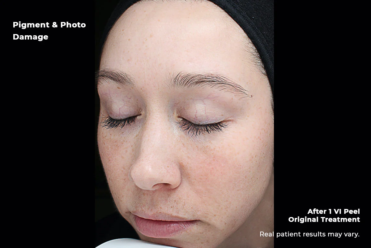 VI Peel pigment and photo damage after 1 treatment — Beauty Ranch Medical Spa