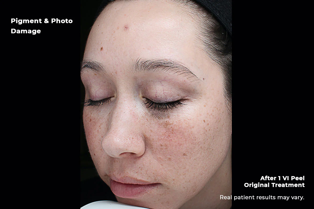 VI Peel pigment and photo damage before — Beauty Ranch Medical Spa